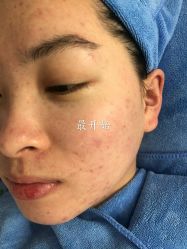 -百世玉芳专业祛痘