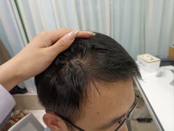 点击看大图 -碧莲盛·不剃发植发