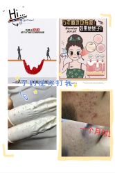 -靓芙泉专研痘痘肌