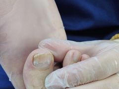 -Andrew指甲专科灰指甲·甲沟炎矫正·3D步态矫形鞋垫定制(浦三路店)