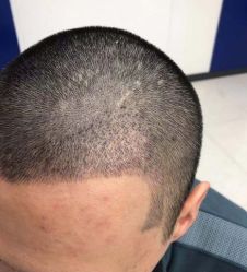 -大麦微针植发全国连锁