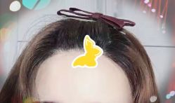 -大麦微针植发全国连锁