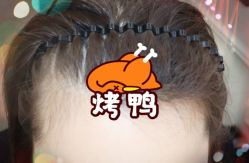 -大麦微针植发全国连锁