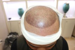 点击看大图 -大麦微针植发丨全国连锁