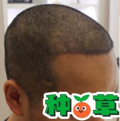 -大麦微针植发丨全国连锁