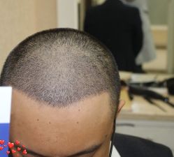 -大麦微针植发丨全国连锁