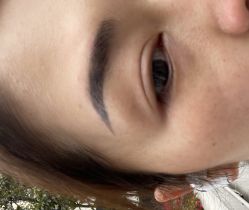 体验前-广州健丽·去眼袋医疗美容机构