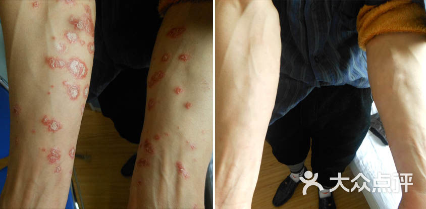 太原哪家皮肤科医院好