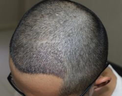 -大麦微针植发全国连锁