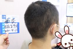 -大麦微针植发丨全国连锁