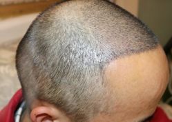 -大麦微针植发丨全国连锁