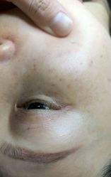-爱莎扁平疣·汗管瘤·斑痣中心