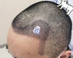 -大麦微针植发全国连锁