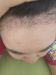 -大麦微针植发丨全国连锁