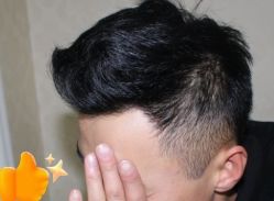 -大麦微针植发丨全国连锁