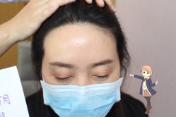 -大麦微针植发丨全国连锁