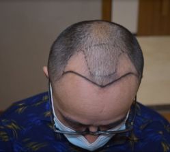 -大麦微针植发全国连锁