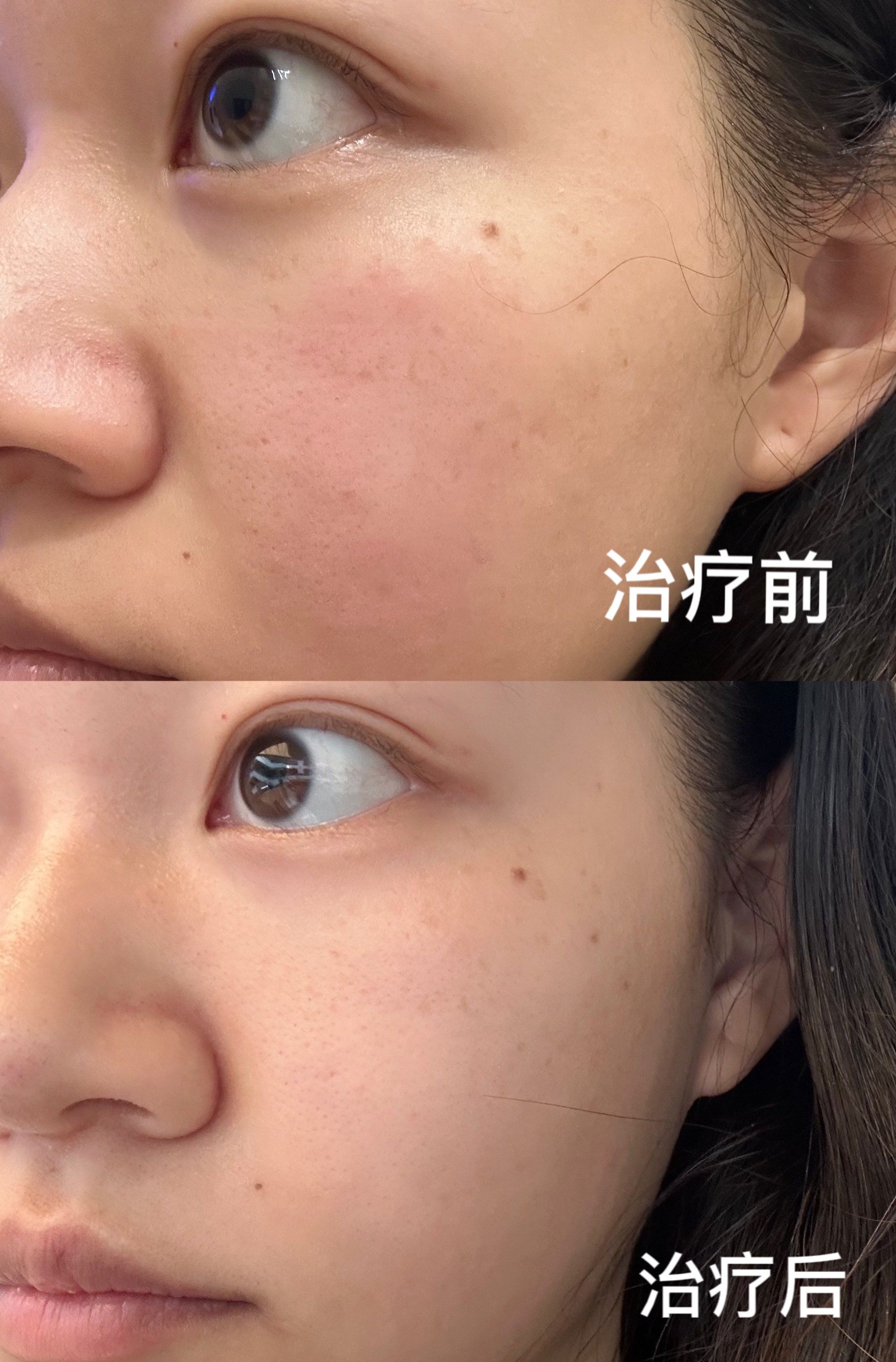 第一次做光子嫩肤效果太棒了吧6015