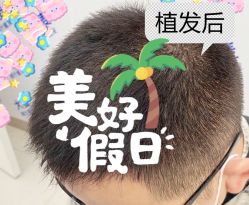 -大麦微针植发全国连锁