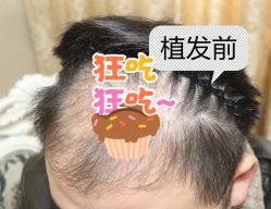 -大麦微针植发全国连锁