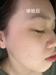 -美丽人生祛斑扁平疣汗管瘤中心
