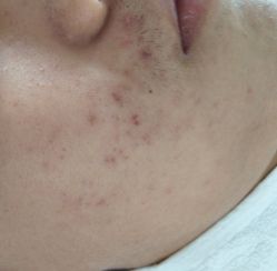 -痘博士北京·全国连锁祛痘机构