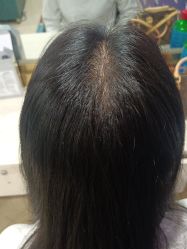 -碧莲盛·不剃发植发