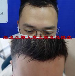 点击看大图 -碧莲盛·不剃发植发