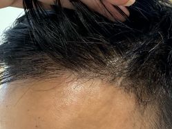 体验后-雍禾植发全国连锁