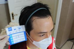 -大麦微针植发丨全国连锁