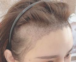 -大麦微针植发全国连锁