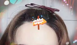 -大麦微针植发全国连锁