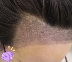 -大麦微针植发丨全国连锁