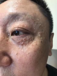 体验前-美丽人生祛斑扁平疣汗管瘤中心