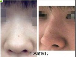 手术前照片-坤如玛丽·医疗美容中心