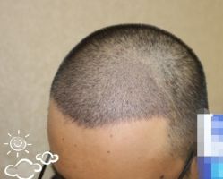 -大麦微针植发丨全国连锁