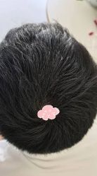 -大麦微针植发丨全国连锁