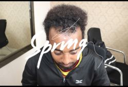 点击看大图 -大麦微针植发全国连锁