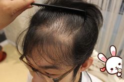 -大麦微针植发丨全国连锁