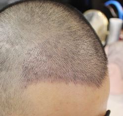 -大麦微针植发丨全国连锁