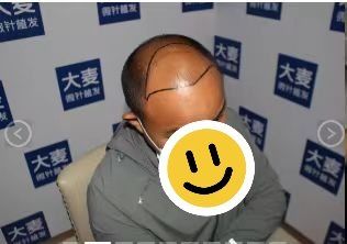 点击看大图 -大麦微针植发丨全国连锁