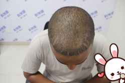 -大麦微针植发丨全国连锁