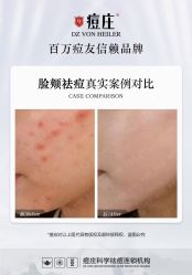 -痘庄科学祛痘国际连锁