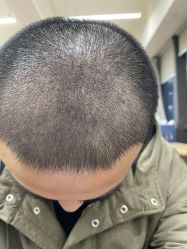 -碧莲盛·不剃发植发