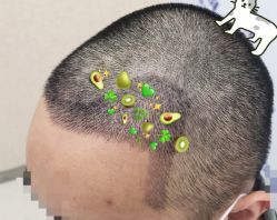 -大麦微针植发全国连锁