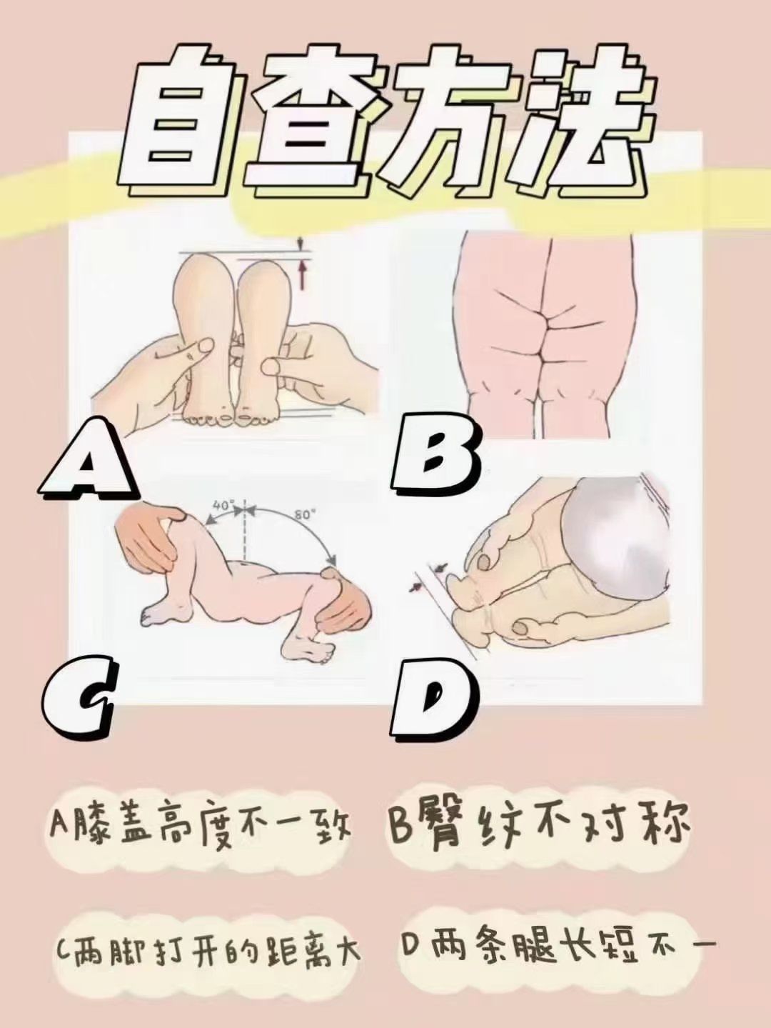 87髋关节发育不良自测方法:
16615腿