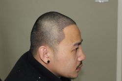 -大麦微针植发丨全国连锁