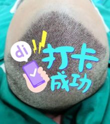 -大麦微针植发全国连锁
