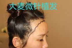 -大麦微针植发丨全国连锁