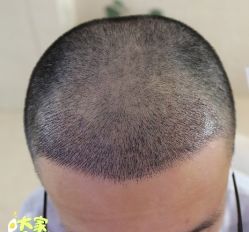 -大麦微针植发丨全国连锁